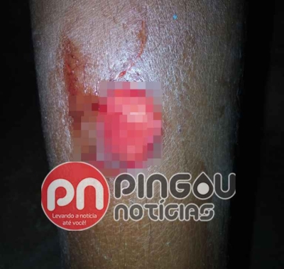 Criança é atacada por piranhas no Rio São Francisco (Imagem: Pingou Notícias)